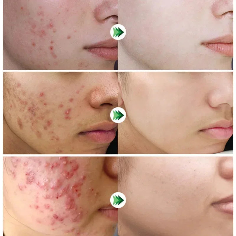 Salicylic Acid Pore Shrinking Cream Eliminate Large Pores Serum Remove Blackhead Acne Repairing Tightening Skin Care Cosmetics