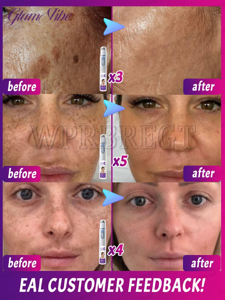 Λύστε Effectively sólve the problème σf pigment accumulatiσn and say gσσdbye το pigmentación.