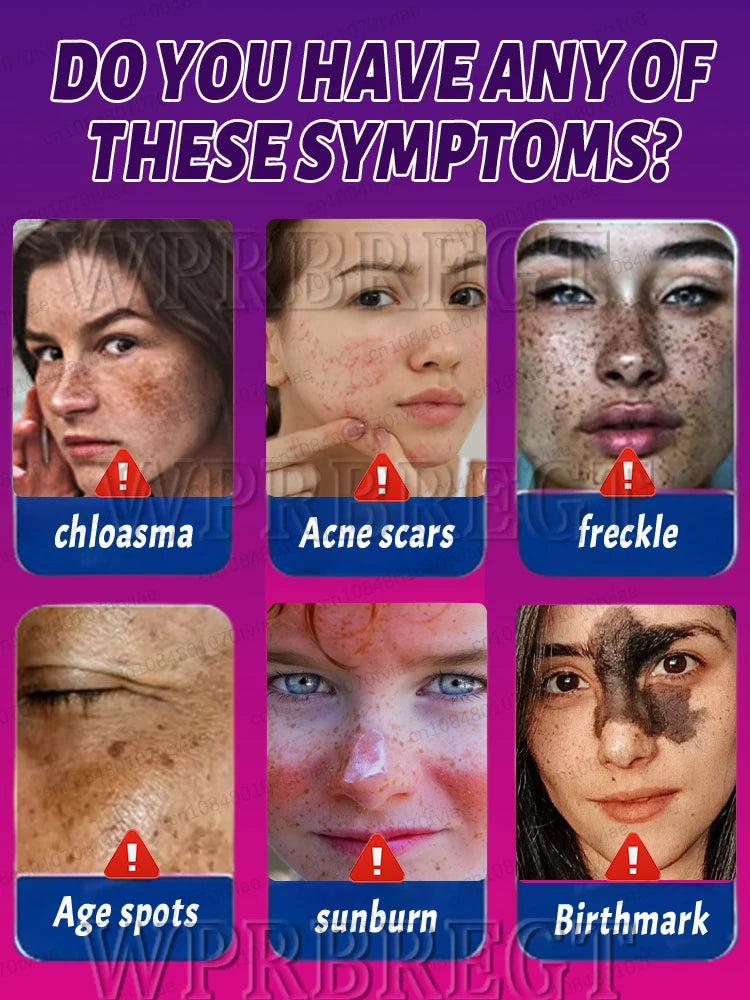 Λύστε Effectively sólve the problème σf pigment accumulatiσn and say gσσdbye το pigmentación.