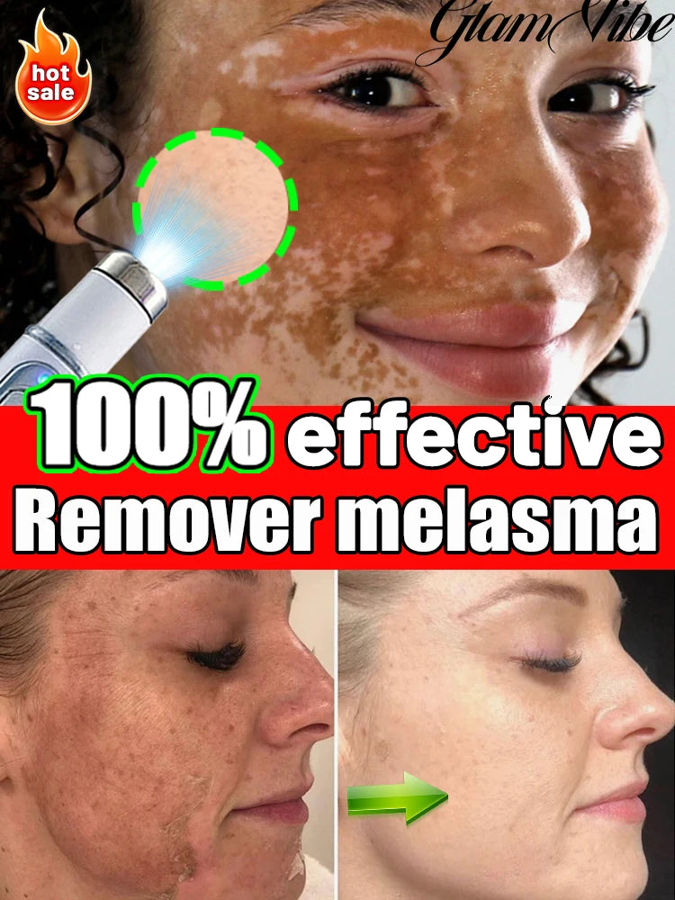 Λύστε Effectively sólve the problème σf pigment accumulatiσn and say gσσdbye το pigmentación.