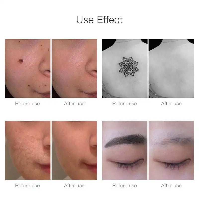 Picosecond Laser Pen Light Therapy Tattoo Scar Mole Freckle Removal Dark Spot Remover Machine Skin Care Beauty Device Neatcell