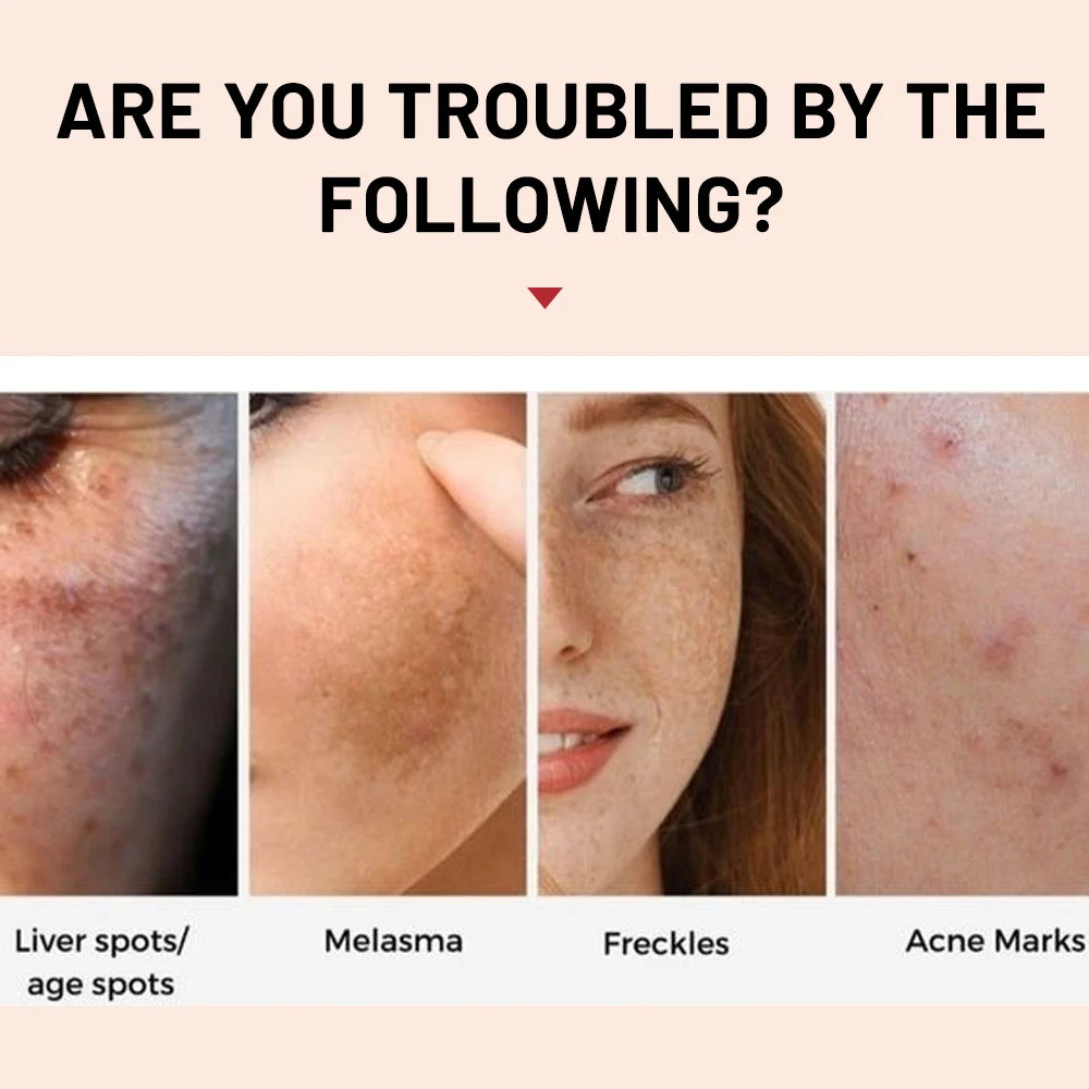 Whitening Freckle Cream Melasma Dark Spots Pigmentation Removal Products Fade Stain Melanin Repair Brighten  Skin Care