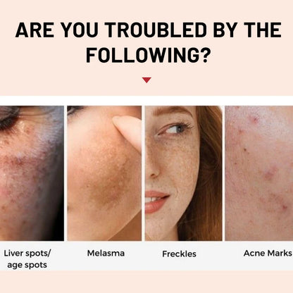 Whitening Freckle Cream Melasma Dark Spots Pigmentation Removal Products Fade Stain Melanin Repair Brighten  Skin Care