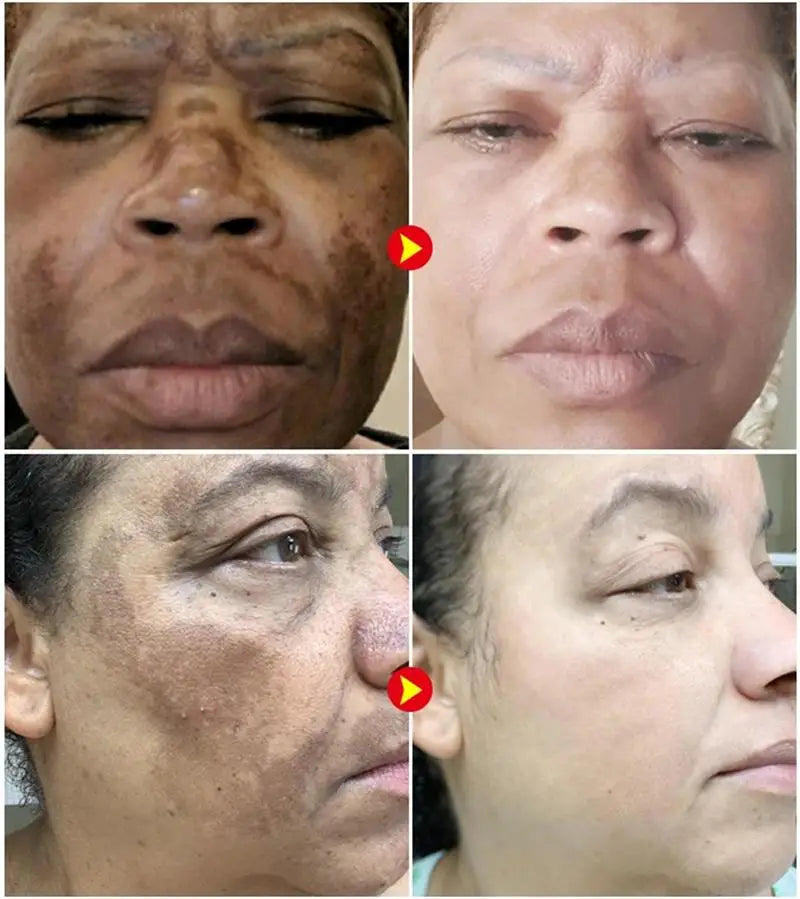 Powerful Spot-removing Whiten Cream Brighten Skin Fast Eliminates Melanin Pigmentation Melasma Dark Spots Moisturize Beauty Gel