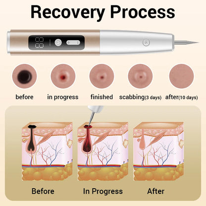 Laser Plasma Pen Mole Wart Skin Tag Remover Black Dots Freckle Dark Spot Wart Eliminator Papilloma Nevus Remover Plasma Pen