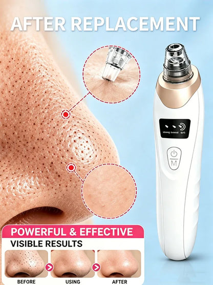 Professional Blackhead Vacuum - Rechargeable Pore Extractor for Blackheads, Oily Skin & Facial Cleansing