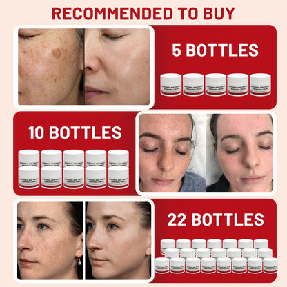 Whitening Freckle Cream Melasma Dark Spots Pigmentation Removal Products Fade Stain Melanin Repair Brighten  Skin Care