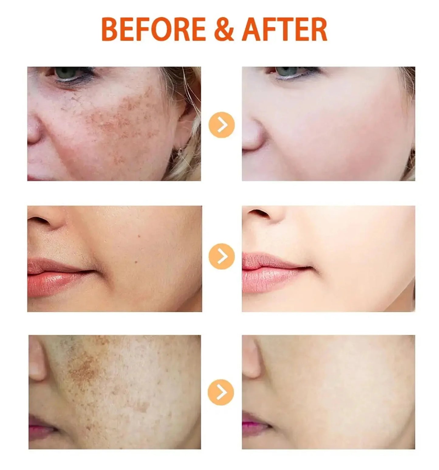 Kojic Acid Freckle Removing Whitening Essence Fade Pigmentation Melasma Dark Spots Corrector Repair Serum Korean Skin Care