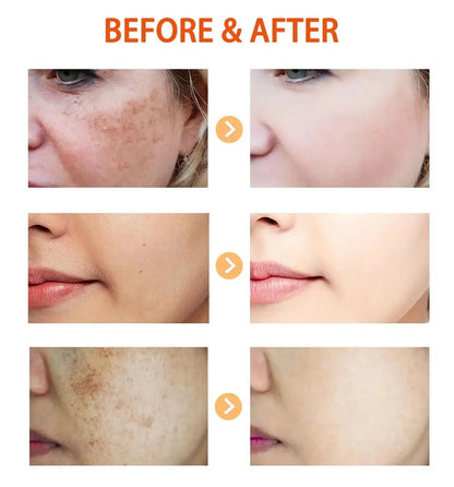 Kojic Acid Freckle Removing Whitening Essence Fade Pigmentation Melasma Dark Spots Corrector Repair Serum Korean Skin Care