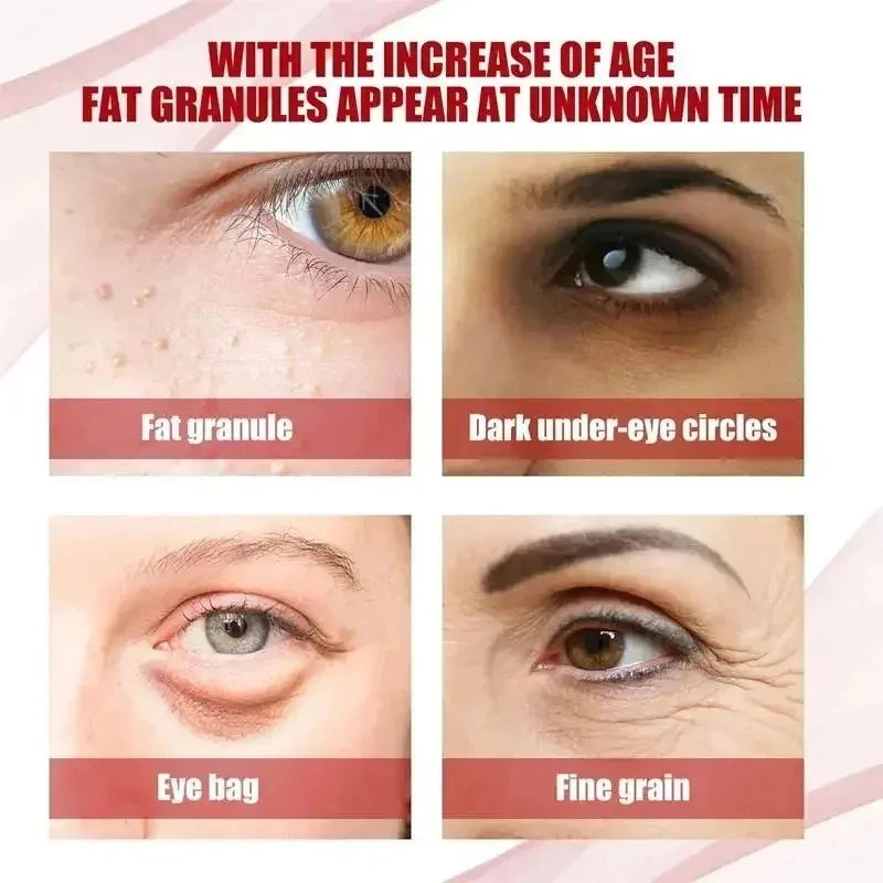 Fat Granules Remover Eye Cream Effective Remove Fat Granules Puffiness Anti-Particles Milia Remover Product Repair Eye Skin Care