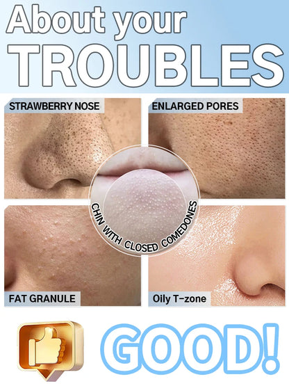 Professional Blackhead Vacuum - Rechargeable Pore Extractor for Blackheads, Oily Skin & Facial Cleansing