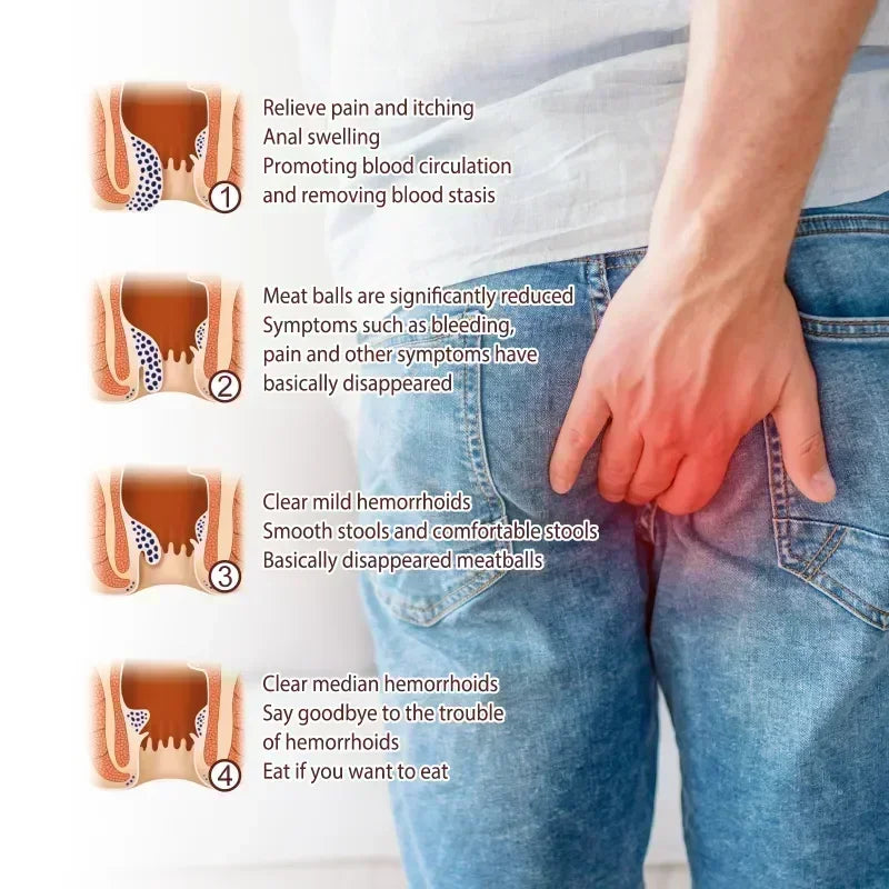 NewHemorrhoid Remover Cream Internal Piles Natural Herbal Extract Relieve Anal Anus Swelling Bleeding Gel Removal Hemorrhoids C