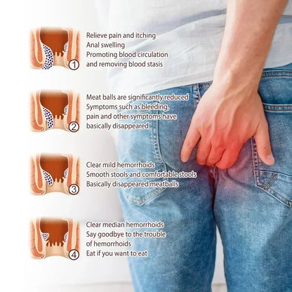 NewHemorrhoid Remover Cream Internal Piles Natural Herbal Extract Relieve Anal Anus Swelling Bleeding Gel Removal Hemorrhoids C