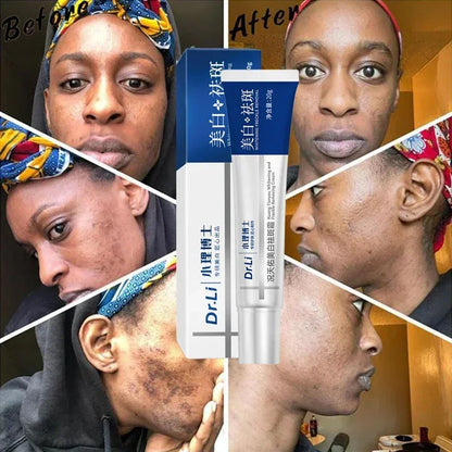 Effective whitening cream for freckles, removes Melasma, dark spots, pigmentation, moisturizer, lightens the face,