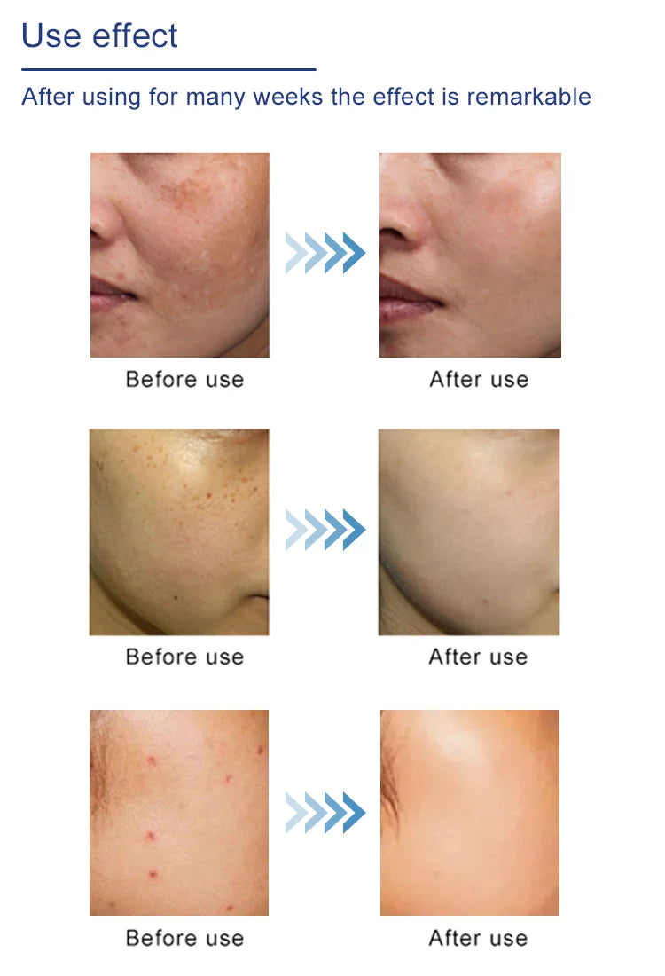 Plasma Pen Cold Skin Tag Wart Remover Dark Spot Fibroblast Therapy Eye Lift Skin Tightening Beauty Device