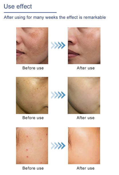 Plasma Pen Cold Skin Tag Wart Remover Dark Spot Fibroblast Therapy Eye Lift Skin Tightening Beauty Device