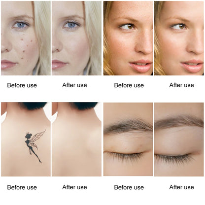 Picosecond Laser Pen Freckle Tattoo Removal Dark Spot Remover Blue & Red Light Machine Portable Scar Mole Remover Beauty Care