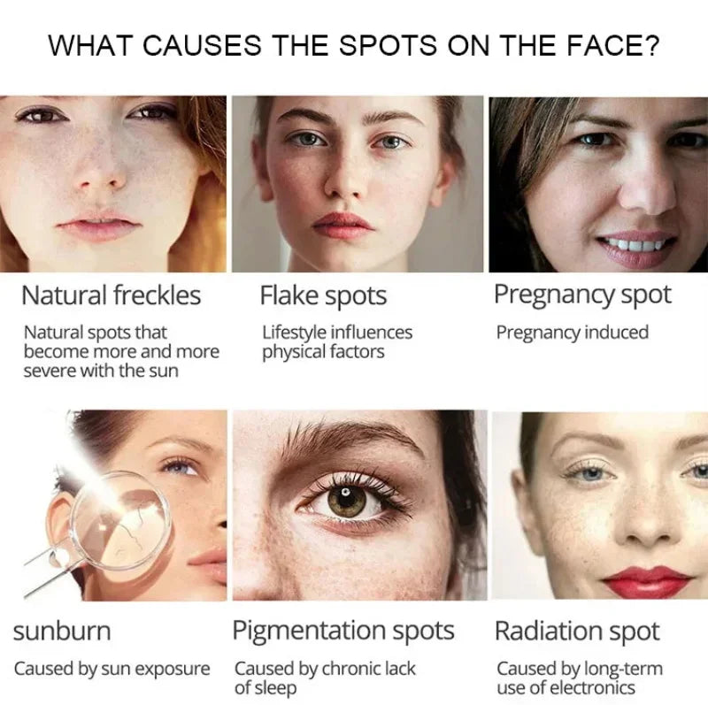 Nicotinamide Intense Anti Dark Spots Serum Cream Whitening Fade Freckles Melasma Remover Treatment Brightening Skin Care 50g