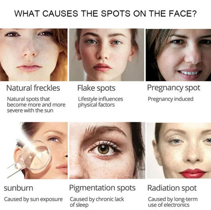 Nicotinamide Intense Anti Dark Spots Serum Cream Whitening Fade Freckles Melasma Remover Treatment Brightening Skin Care 50g