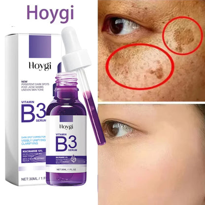 Hoygi Niacinamide Facial Serum Vitamin B3 Wrinkles Pigment Dark Spot Removal Correcting Glow Serum Face Whitening Moisturizer