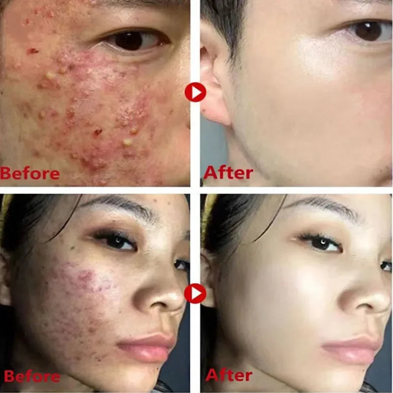 Original Facial Remove Blackhead Green Tea Solid Mask Treat Acne Blemish Black Dots Clean Stick Cream Shrink Pores Skin Care