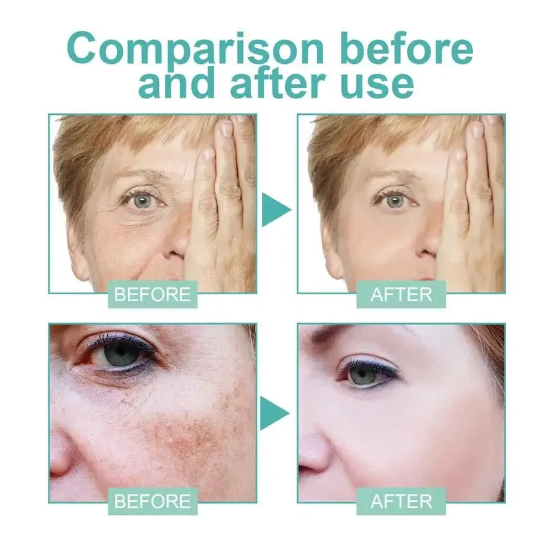 Powerful Spot-removing Whiten Cream Brighten Skin Fast Eliminates Melanin Pigmentation Melasma Dark Spots Moisturize Beauty Gel