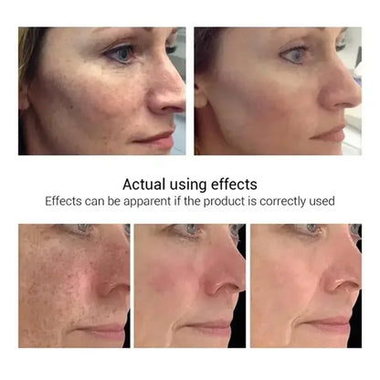 Effective whitening cream for freckles, removes Melasma, dark spots, pigmentation, moisturizer, lightens the face,