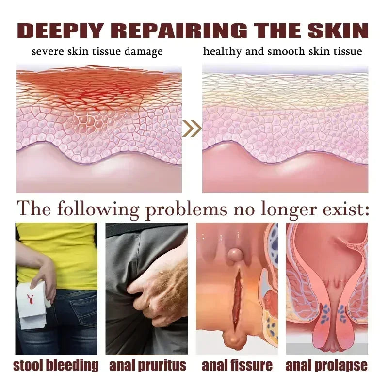 NewHemorrhoid Remover Cream Internal Piles Natural Herbal Extract Relieve Anal Anus Swelling Bleeding Gel Removal Hemorrhoids C