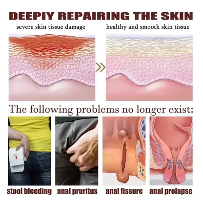 NewHemorrhoid Remover Cream Internal Piles Natural Herbal Extract Relieve Anal Anus Swelling Bleeding Gel Removal Hemorrhoids C
