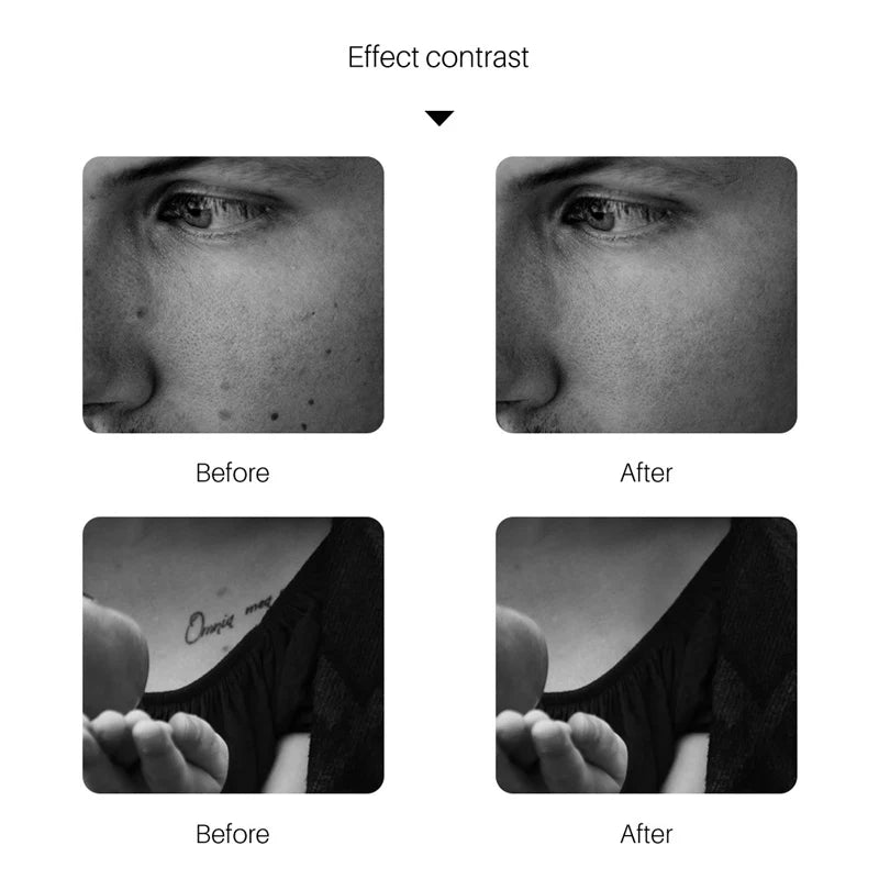 Picosecond Laser Pen Freckle Tattoo Removal Dark Spot Remover Blue & Red Light Machine Portable Scar Mole Remover Beauty Care