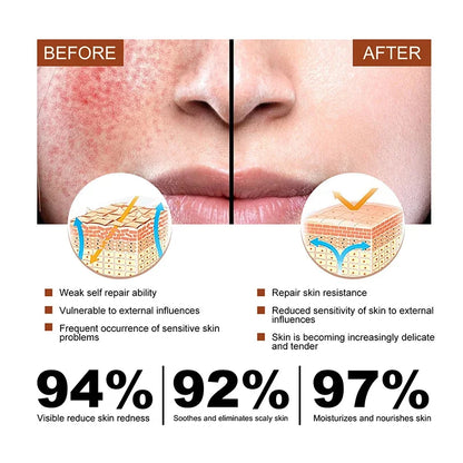 B5 Repair Facial Redness Cream Instant Spider Vein Remove Sensitive Skin Sooth Anti Redness Rosacea Treat Lotion Korean Cosmetic