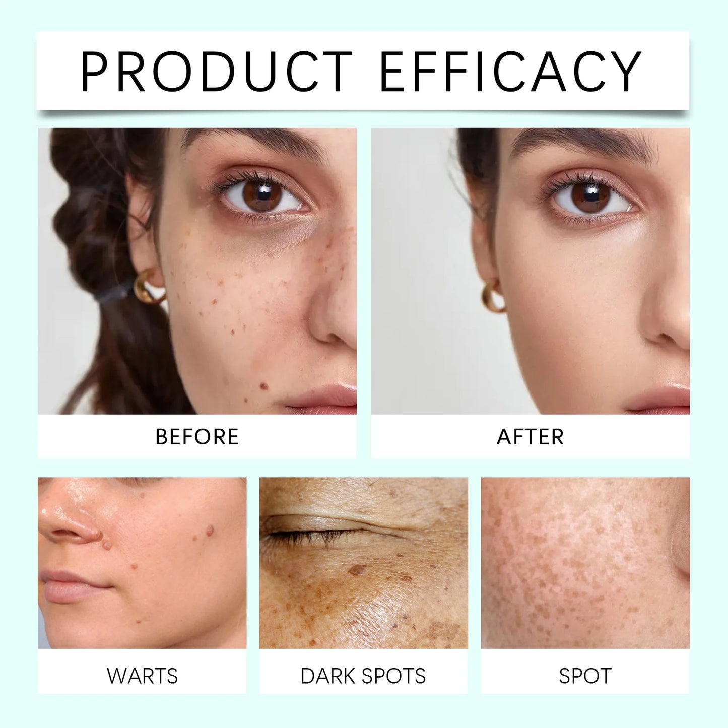 Face Beauty Laser Pen Improve Dark Spot Freckles Pigmentation Lighten Dull Skin Glowing Painless Facial Blemishes Removal Device