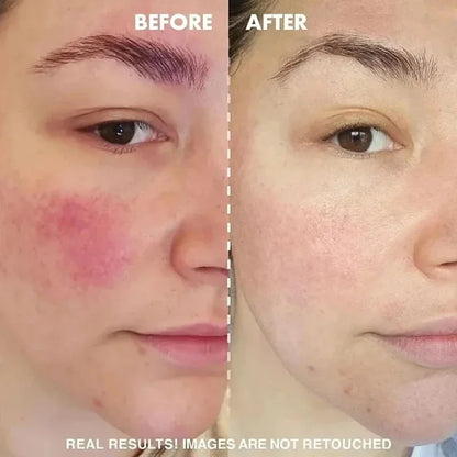 B5 Repair Facial Redness Cream Instant Spider Vein Remove Sensitive Skin Sooth Anti Redness Rosacea Treat Lotion Korean Cosmetic