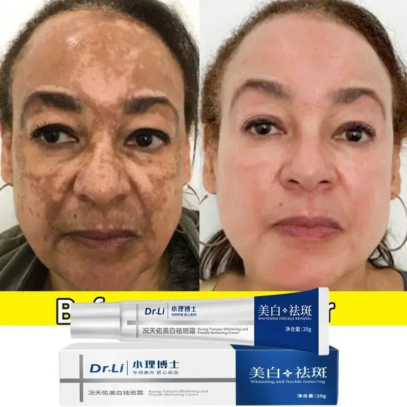 Effective whitening cream for freckles, removes Melasma, dark spots, pigmentation, moisturizer, lightens the face,