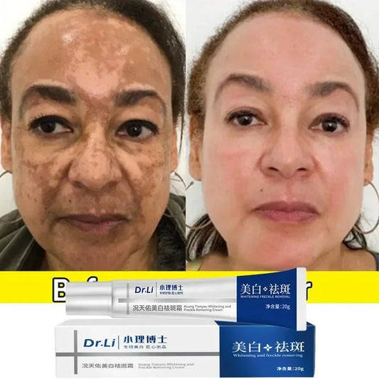 Effective whitening cream for freckles, removes Melasma, dark spots, pigmentation, moisturizer, lightens the face,