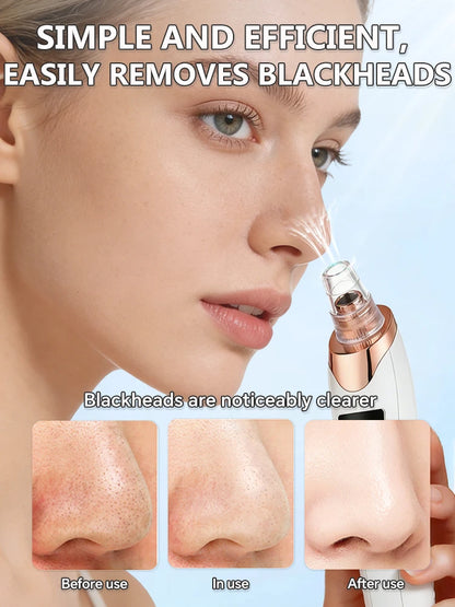 Professional Blackhead Vacuum - Rechargeable Pore Extractor for Blackheads, Oily Skin & Facial Cleansing