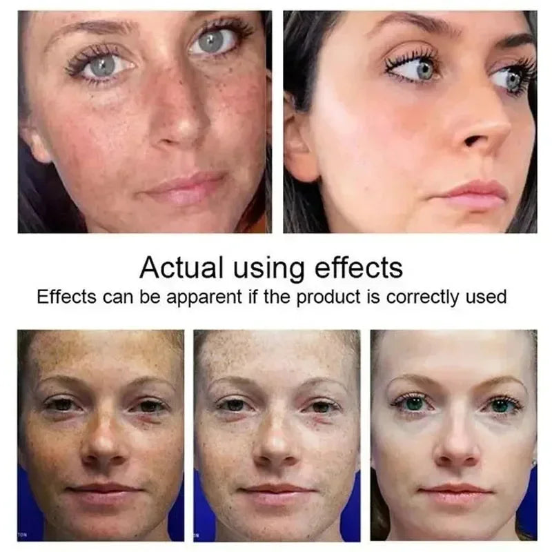 Kojic Acid Freckle Removing Whitening Essence Fade Pigmentation Melasma Dark Spots Corrector Repair Serum Korean Skin Care