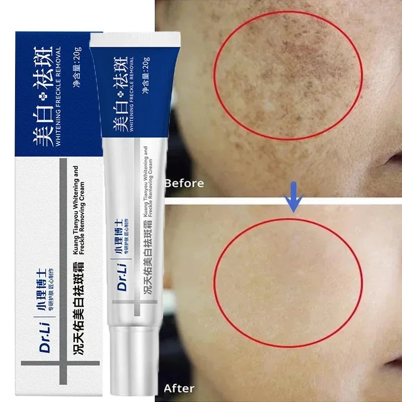 Effective whitening cream for freckles, removes Melasma, dark spots, pigmentation, moisturizer, lightens the face,
