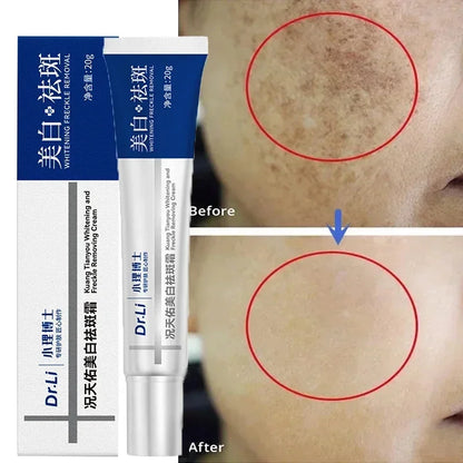 Effective whitening cream for freckles, removes Melasma, dark spots, pigmentation, moisturizer, lightens the face,