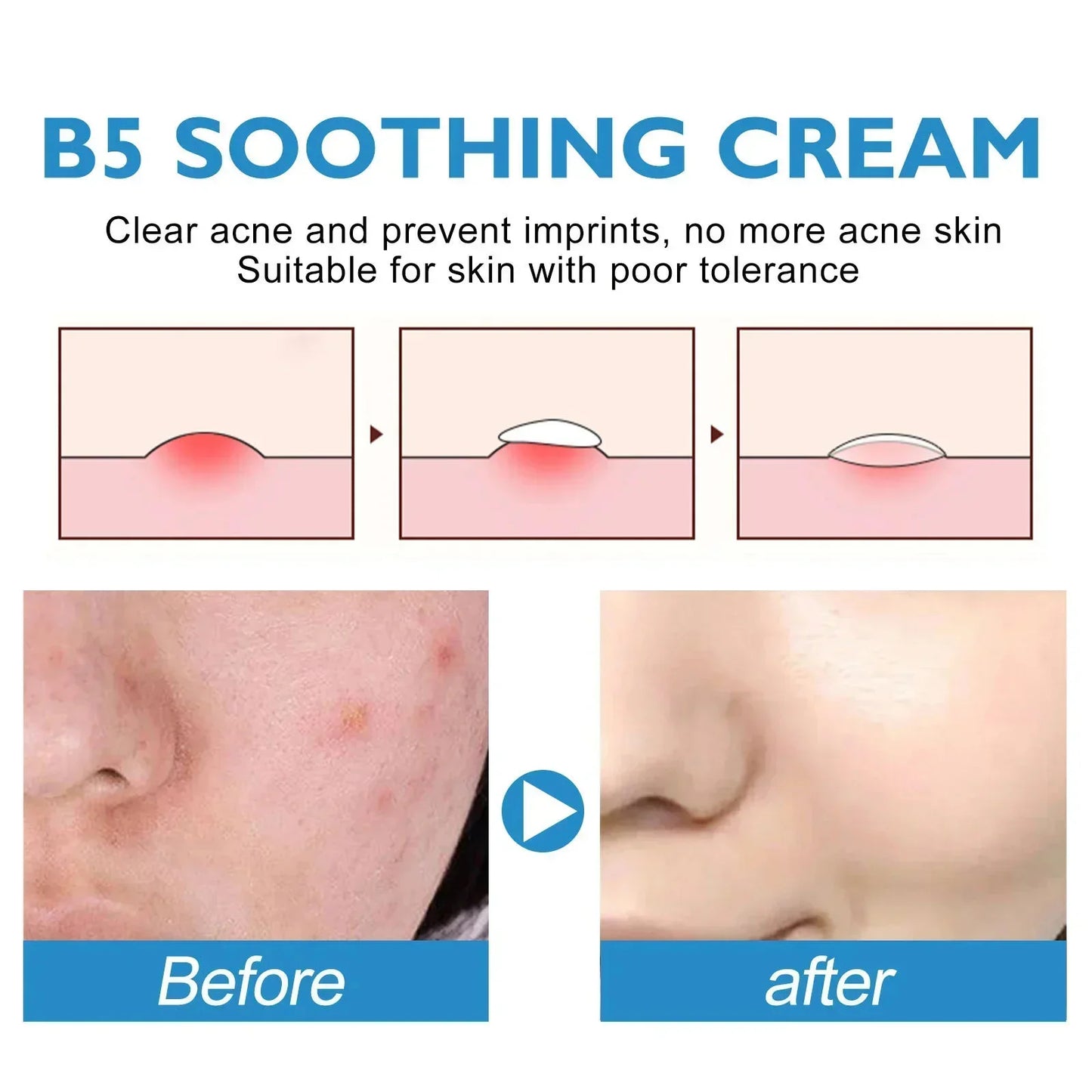 Repair Facial Redness Cream Instant Spider Vein Remove Sensitive Skin Sooth Anti Redness Rosacea Treat Lotion Korean Cosmetics