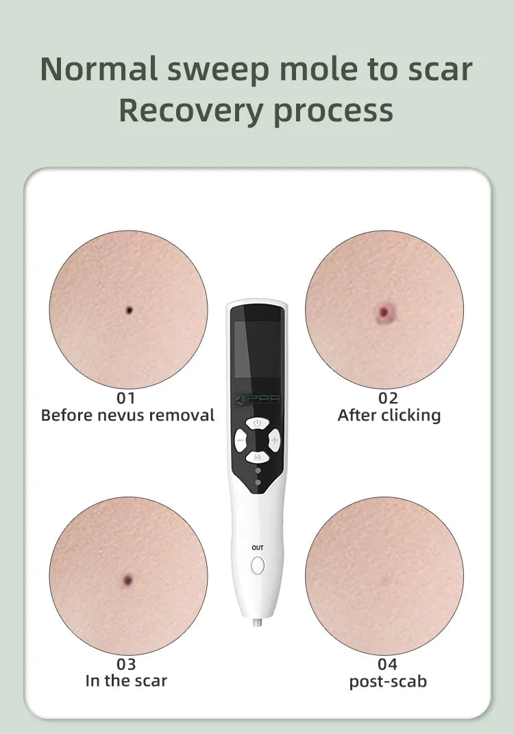 Portable 2 In 1 Plasma Ozone For Acne Beauty Plasma Laser Pen For Eye Lift Wrinkle Removal spot Removal Pen mole Remover Pen