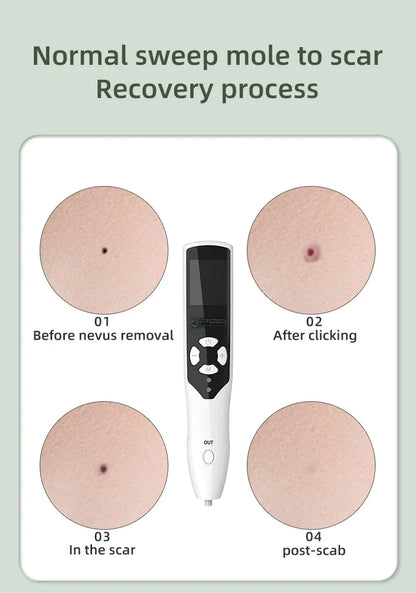 Portable 2 In 1 Plasma Ozone For Acne Beauty Plasma Laser Pen For Eye Lift Wrinkle Removal spot Removal Pen mole Remover Pen