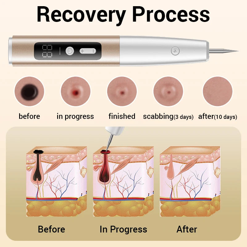 Laser Plasma Pen Mole Wart Skin Tag Remover Black Dots Freckle Dark Spot Wart Eliminator Papilloma Nevus Remover Plasma Pen