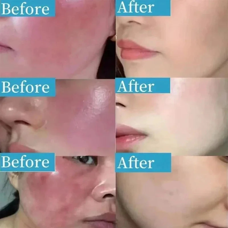 B5 Repair Facial Redness Cream Instant Spider Vein Remove Sensitive Skin Sooth Anti Redness Rosacea Treat Lotion Korean Cosmetic