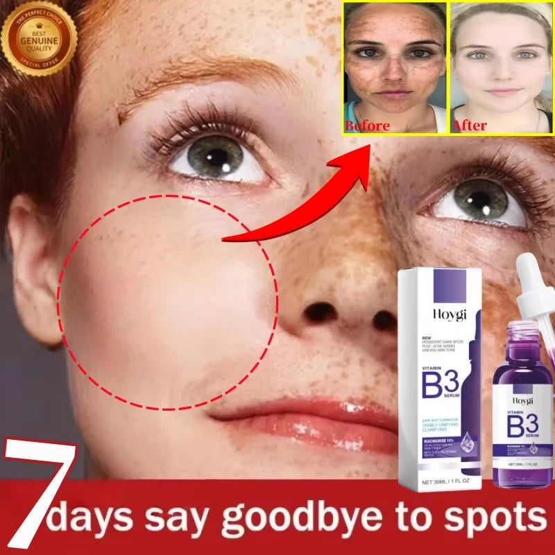 Hoygi Niacinamide Facial Serum Vitamin B3 Wrinkles Pigment Dark Spot Removal Correcting Glow Serum Face Whitening Moisturizer