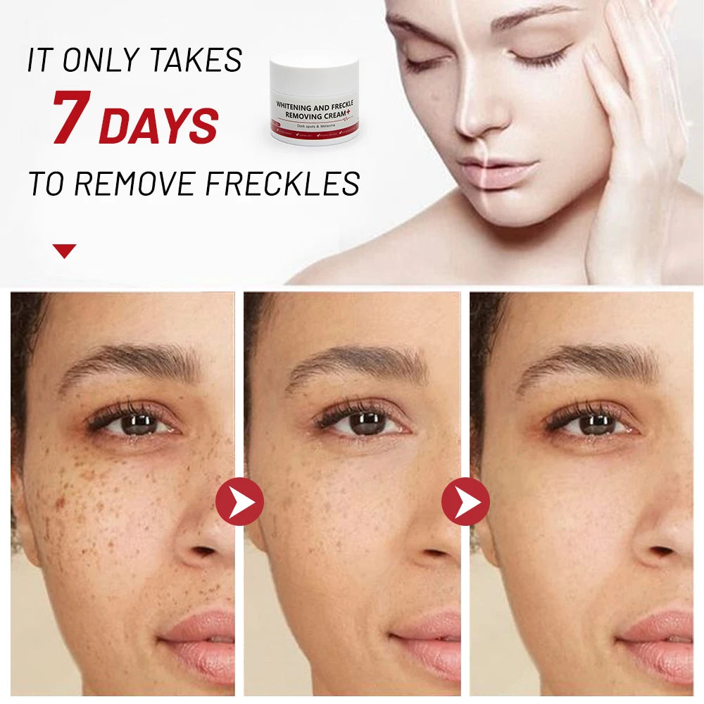 Whitening Freckle Cream Melasma Dark Spots Pigmentation Removal Products Fade Stain Melanin Repair Brighten  Skin Care