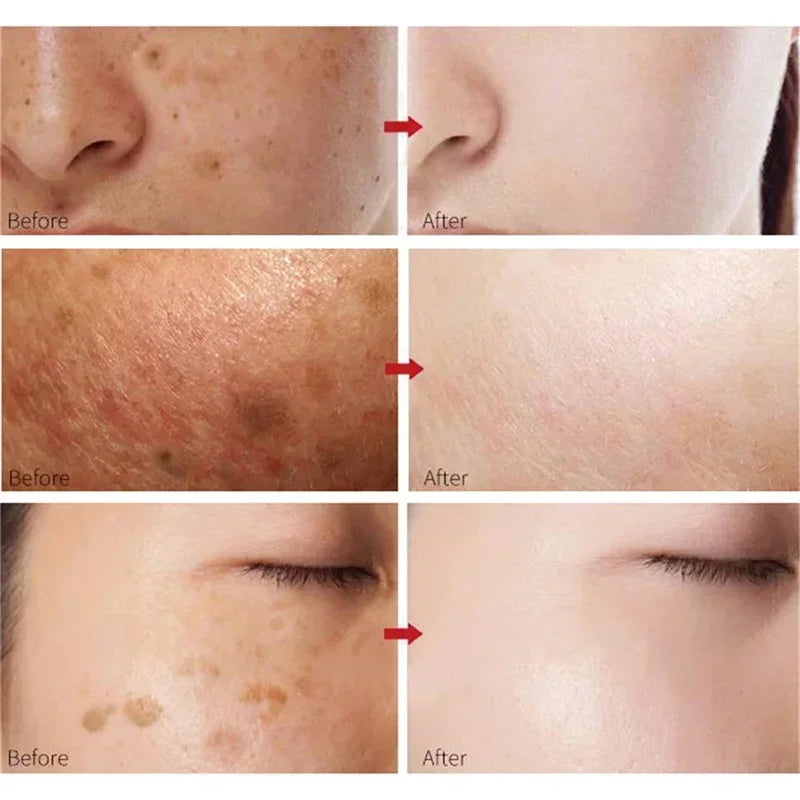 Effective whitening cream for freckles, removes Melasma, dark spots, pigmentation, moisturizer, lightens the face,