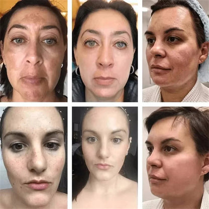 Powerful Spot-Removing Whiten Cream Brighten Skin Fast Eliminates Melanin Pigmentation Melasma Dark Spots Korean Face Skin Care
