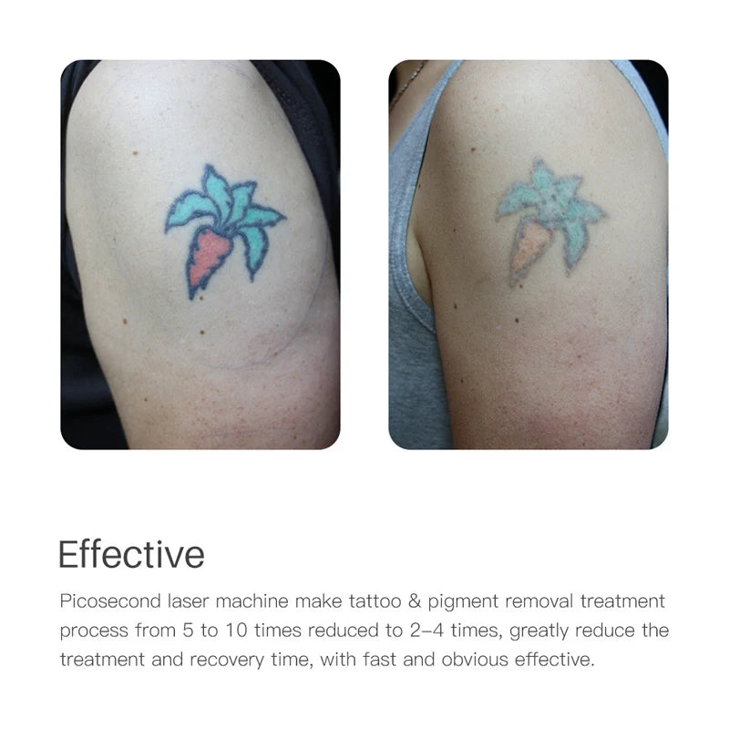 Picosecond Laser Pen Freckle Tattoo Removal Dark Spot Remover Blue & Red Light Machine Portable Scar Mole Remover Beauty Care