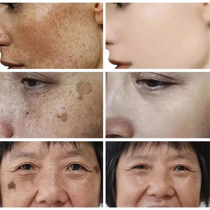 Powerful Spot-Removing Whiten Cream Brighten Skin Fast Eliminates Melanin Pigmentation Melasma Dark Spots Korean Face Skin Care